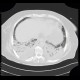 Pumonary edema, pneumonia: CT - Computed tomography